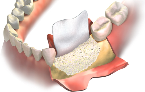 infografía explicativa de refeneración ósea