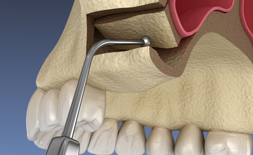 infografía explicativa de elevación de senos