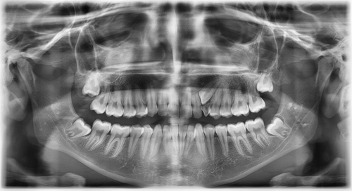 ortopantomografía de ECCO