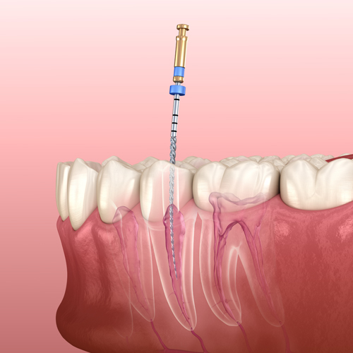 gráfico explicativo de endodoncia