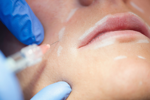 doctor de ECCO inyectando ácido hialurónico