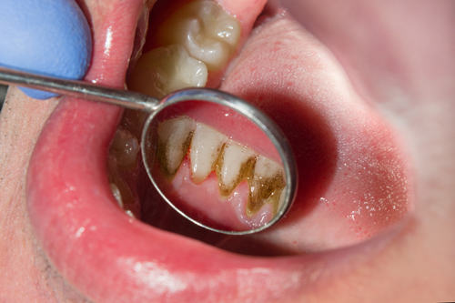 imagen de dientes con sarro en la cara interna de los dientes