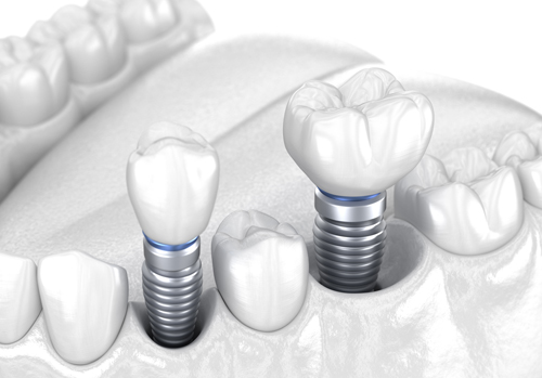 infografía esquemática de implantes