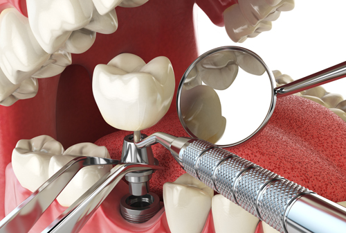 infografía del instrumental usado en implantes