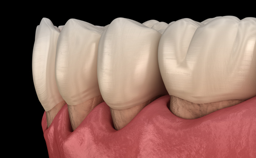 infografía de dientes con la raíz expuesta